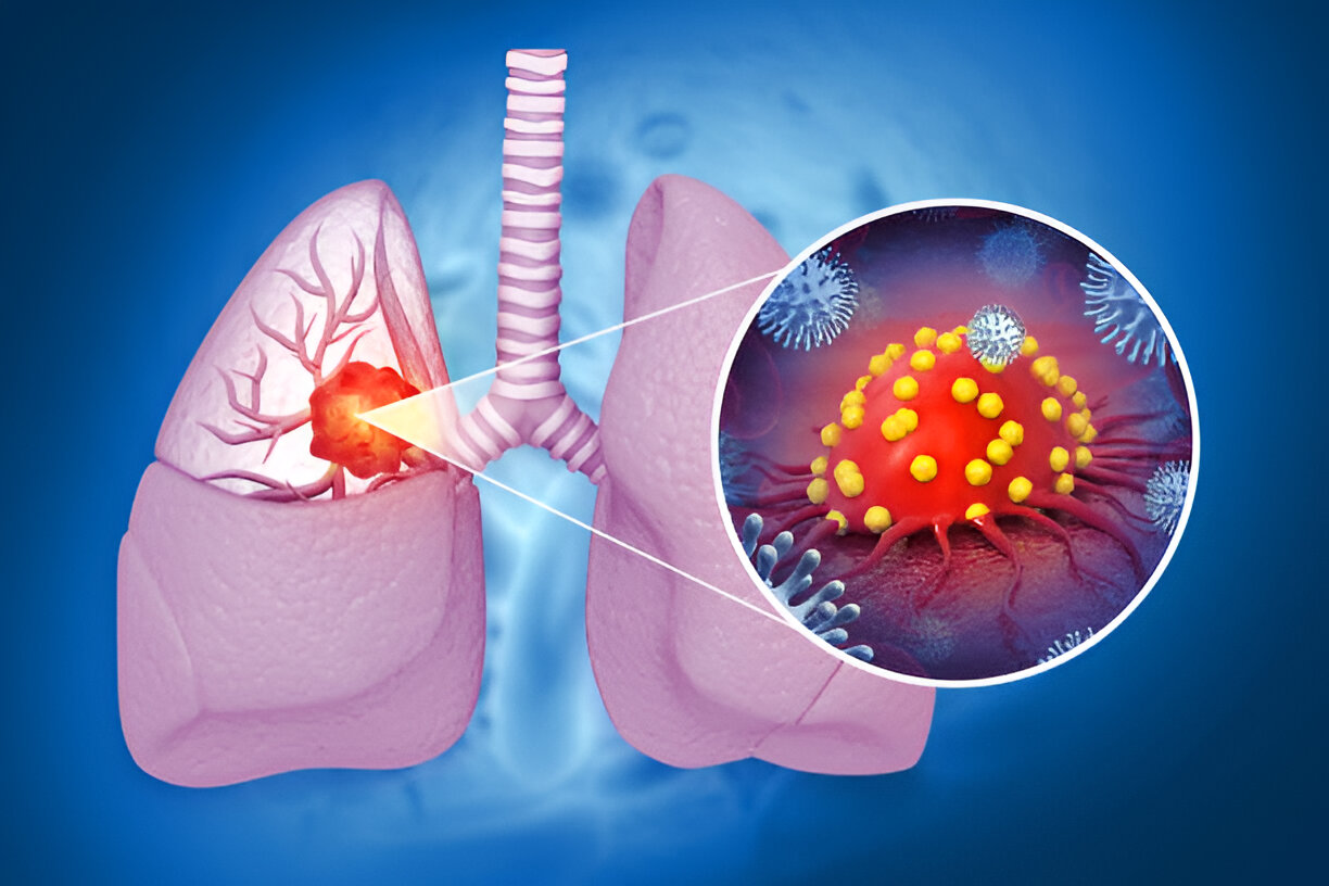 Interstitial Lung Diseases / Lung Fibrosis